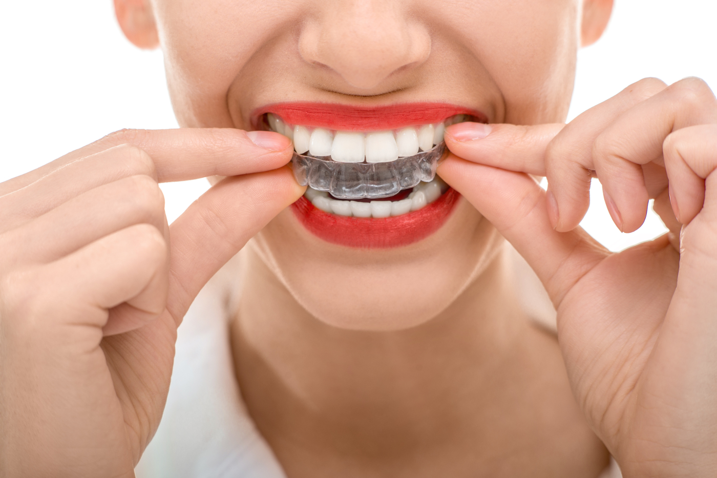 Invisalign 